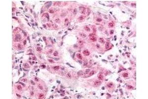 Affinity Purified anti- E2F-1 pS364 antibody was used at a 10 µg/ml to detect nuclear and occasion-ally cytoplasmic signal in a variety of tissues in-cluding multi-human, multi-brain and multi-cancer slides. (E2F1 Antikörper  (pSer364))