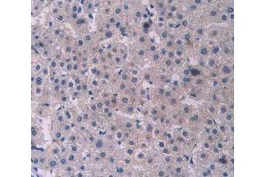 IHC-P analysis of liver cancer tissue, with DAB staining. (PCOLCE Antikörper  (AA 315-437))