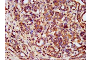 IHC image of ABIN7159577 diluted at 1:400 and staining in paraffin-embedded human pancreatic cancer performed on a Leica BondTM system. (METAP1 Antikörper  (AA 54-125))