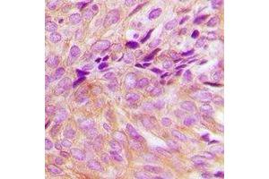 Immunohistochemical analysis of GNA13 staining in human breast cancer formalin fixed paraffin embedded tissue section. (GNA13 Antikörper)