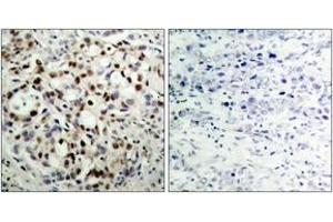 Immunohistochemistry analysis of paraffin-embedded human breast carcinoma, using CREB (Phospho-Ser133) Antibody. (CREB1 Antikörper  (pSer133))