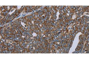 Immunohistochemistry of paraffin-embedded Human ovarian cancer using NDUFA13 Polyclonal Antibody at dilution of 1:50 (NDUFA13 Antikörper)