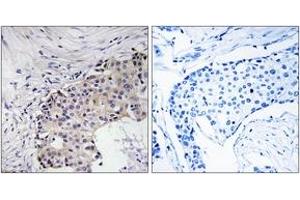 Immunohistochemistry analysis of paraffin-embedded human breast carcinoma, using SCARF2 Antibody. (SCARF2 Antikörper  (AA 677-726))