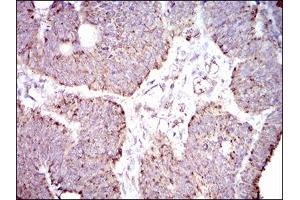 Immunohistochemical analysis of paraffin-embedded rectum cancer tissues using ALDH2 mouse mAb with DAB staining. (ALDH2 Antikörper  (AA 317-517))