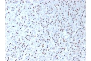 Formalin-fixed, paraffin-embedded human Mesothelioma stained with Wilm's Tumor Rabbit Recombinant Monoclonal Antibody (WT1/1434R). (Rekombinanter WT1 Antikörper)