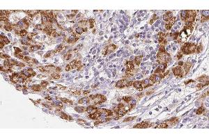 ABIN6277936 at 1/100 staining Human liver cancer tissue by IHC-P. (PNPLA2 Antikörper  (Internal Region))