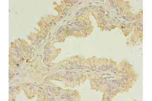 Immunohistochemistry of paraffin-embedded human prostate cancer using ABIN7174434 at dilution of 1:100 (UBE2D1 Antikörper  (AA 1-147))