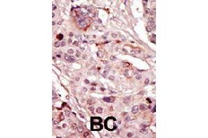 Formalin-fixed and paraffin-embedded human cancer tissue reacted with SRMS polyclonal antibody  , which was peroxidase-conjugated to the secondary antibody, followed by AEC staining. (SRMS Antikörper  (C-Term))
