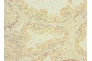 Immunohistochemistry of paraffin-embedded human prostate cancer using ABIN7168448 at dilution of 1:100 (RGR Antikörper  (AA 152-291))