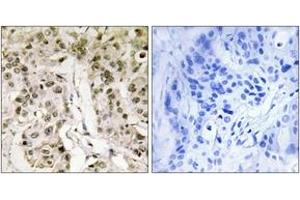 Immunohistochemistry analysis of paraffin-embedded human breast carcinoma tissue, using HCFC1 Antibody. (HCFC1 Antikörper  (AA 131-180))