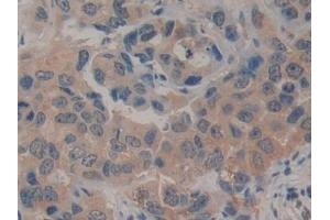 Detection of CD161 in Human Breast cancer Tissue using Polyclonal Antibody to Cluster Of Differentiation 161 (CD161) (CD161 Antikörper  (AA 73-188))