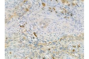 ABIN6264095 and ABIN6273290 at 1/100 staining human tongue carcinoma by IHC-P. (PDE6A Antikörper  (N-Term))