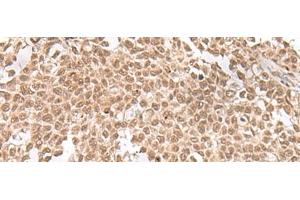 Immunohistochemistry of paraffin-embedded Human ovarian cancer tissue using ZNF560 Polyclonal Antibody at dilution of 1:25(x200) (ZNF560 Antikörper)
