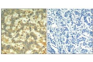 Immunohistochemical analysis of paraffin-embedded human breast carcinoma tissue using syk(Phospho-Tyr323) Antibody(left) or the same antibody preincubated with blocking peptide(right).