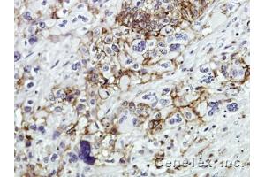 IHC-P Image Immunohistochemical analysis of paraffin-embedded Human pancreatic tumor, using CD44, antibody at 1:100 dilution. (CD44 Antikörper)