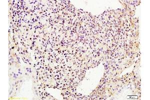 Formalin-fixed and human breast carcinoma tissue labeled with Anti-phospho-BACH1/BRIP1(Ser990) Polyclonal Antibody, Unconjugated  at 1:200 followed by conjugation to the secondary antibody and DAB staining (BRIP1 Antikörper  (pSer990))