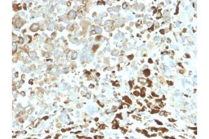 Formalin-fixed, paraffin-embedded human Melanoma stained with NGFR Rabbit Recombinant Monoclonal Antibody (NGFR/2550R). (Rekombinanter NGFR Antikörper  (AA 281-421))