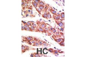 Formalin-fixed and paraffin-embedded human hepatocellular carcinoma tissue reacted with USP12 polyclonal antibody  , which was peroxidase-conjugated to the secondary antibody, followed by AEC staining .