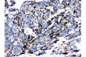 Anti- Ataxin 1 Picoband antibody, IHC(P) IHC(P): Human Lung Cancer Tissue (Ataxin 1 Antikörper  (C-Term))