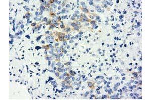 Immunohistochemical staining of paraffin-embedded Adenocarcinoma of Human ovary tissue using anti-LIN7B mouse monoclonal antibody. (LIN7B Antikörper)