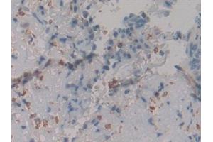 Detection of CR in Human Skin cancer Tissue using Polyclonal Antibody to Calretinin (CR) (Calretinin Antikörper  (AA 28-248))