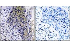 Immunohistochemistry analysis of paraffin-embedded human lung carcinoma tissue, using MRPL34 Antibody.