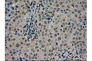 Immunohistochemical staining of paraffin-embedded Carcinoma of thyroid tissue using anti-SCYL3mouse monoclonal antibody. (SCYL3 Antikörper)