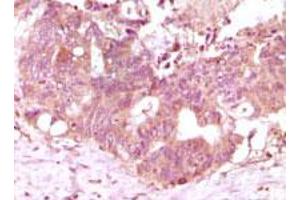 Immunohistochemical analysis of paraffin-embedded human recturn adenocarcinoma tissue showing cytoplasmic localization using FGF2 monoclonal antibody, clone 2H5G2C11  with DAB staining.