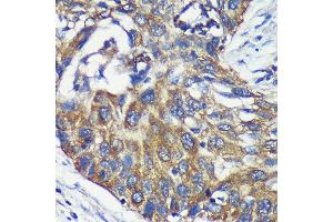 Immunohistochemistry of paraffin-embedded Human lung cancer using L Rabbit pAb (ABIN7265386) at dilution of 1:100 (40x lens). (ARPC5L Antikörper  (AA 1-100))