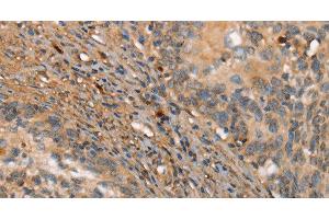 Immunohistochemistry of paraffin-embedded Human cervical cancer tissue using HK3 Polyclonal Antibody at dilution 1:40 (HK3 Antikörper)