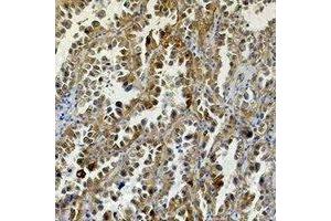Immunohistochemical analysis of Carbonic Anhydrase 9 staining in human lung cancer formalin fixed paraffin embedded tissue section. (CA9 Antikörper)