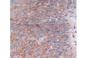 IHC-P analysis of skin cancer tissue, with DAB staining. (DHODH Antikörper  (AA 35-392))