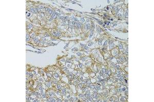 Immunohistochemistry of paraffin-embedded human gastric cancer using CHMP4B antibody. (CHMP4B Antikörper  (AA 1-224))