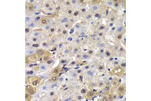 Immunohistochemistry of paraffin-embedded human liver cancer using MAD1L1 antibody at dilution of 1:100 (400x lens). (MAD1L1 Antikörper)