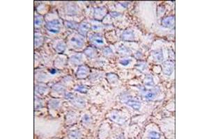 Formalin-fixed and paraffin-embedded human breast carcinoma tissue reacted with ERK8 antibody (N-term), which was peroxidase-conjugated to the secondary antibody, followed by DAB staining. (MAPK15 Antikörper  (N-Term))