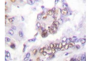 Immunohistochemistry analyzes of AML1 antibody in paraffin-embedded human lung carcinoma tissue. (RUNX1 Antikörper)