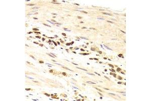 Immunohistochemistry of paraffin-embedded human gastric cancer using PRPF3 Antibody. (PRPF3 Antikörper  (AA 1-280))