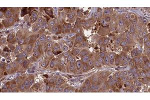 ABIN6273681 at 1/100 staining Human liver cancer tissue by IHC-P. (JAML Antikörper  (C-Term))