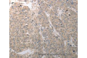 Immunohistochemistry of Human liver cancer using SLC1A4 Polyclonal Antibody at dilution of 1:70 (SLC1A4 Antikörper)