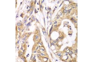 Immunohistochemistry of paraffin-embedded human liver cancer using TXNRD2 antibody. (TXNRD2 Antikörper  (AA 100-310))