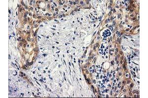 Immunohistochemical staining of paraffin-embedded Carcinoma of Human pancreas tissue using anti-BCAR1 mouse monoclonal antibody. (BCAR1 Antikörper)