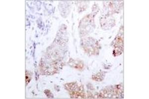 Immunohistochemistry analysis of paraffin-embedded human breast carcinoma tissue, using C-RAF (Ab-259) Antibody. (RAF1 Antikörper  (AA 225-274))