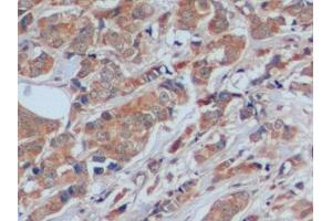 Detection of FN in Human Breast cancer Tissue using Polyclonal Antibody to Fibronectin (FN) (Fibronectin Antikörper  (AA 1998-2106))