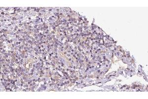 ABIN6273152 at 1/100 staining Human lymph cancer tissue by IHC-P. (PYGB Antikörper  (C-Term))