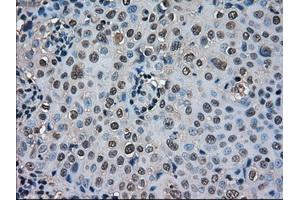 Immunohistochemical staining of paraffin-embedded Carcinoma of thyroid tissue using anti-SOD1mouse monoclonal antibody. (SOD1 Antikörper)