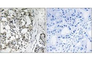 Immunohistochemistry analysis of paraffin-embedded human breast carcinoma tissue, using PEX14 Antibody. (PEX14 Antikörper  (AA 117-166))