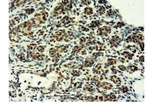 Immunohistochemical staining of paraffin-embedded Human breast tissue using anti-EPM2AIP1 mouse monoclonal antibody. (EPM2AIP1 Antikörper)