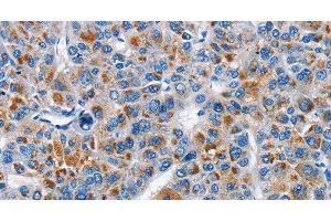 Immunohistochemistry of paraffin-embedded Human liver cancer tissue using CREB2 Polyclonal Antibody at dilution 1:40 (ATF4 Antikörper)