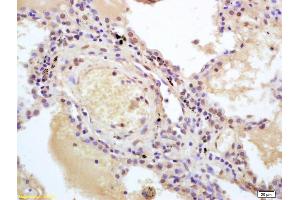 Formalin-fixed and paraffin embedded human lung carcinoma labeled with Anti-IRF7 Polyclonal Antibody, Unconjugated (ABIN682603) at 1:200 followed by conjugation to the secondary antibody and DAB staining. (IRF7 Antikörper  (AA 401-503))