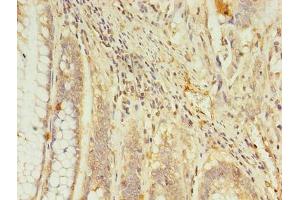 Immunohistochemistry of paraffin-embedded human colon cancer using ABIN7167621 at dilution of 1:100 (RGS7 Antikörper  (AA 1-487))